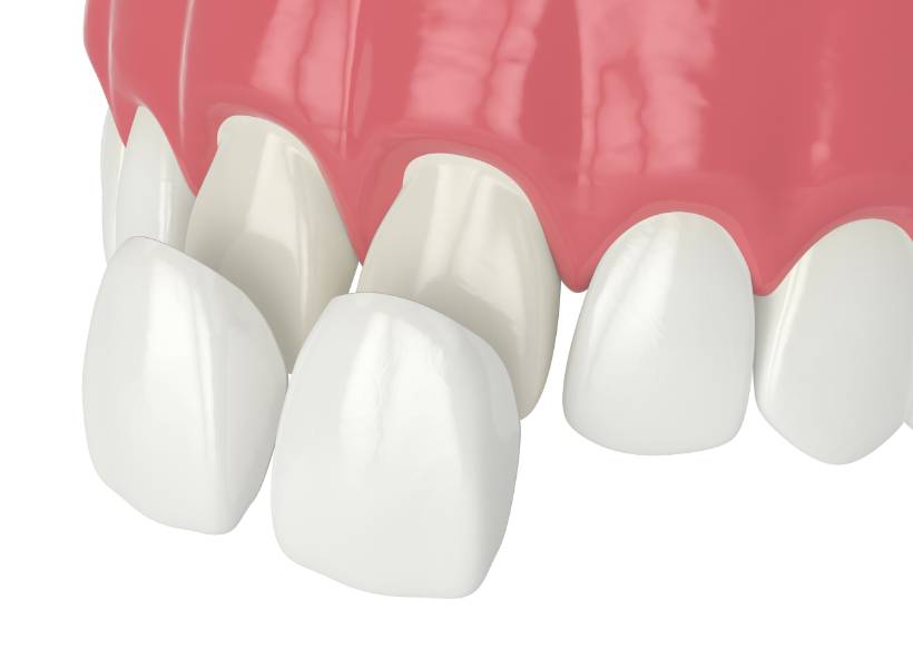 Dental veneer illustration
