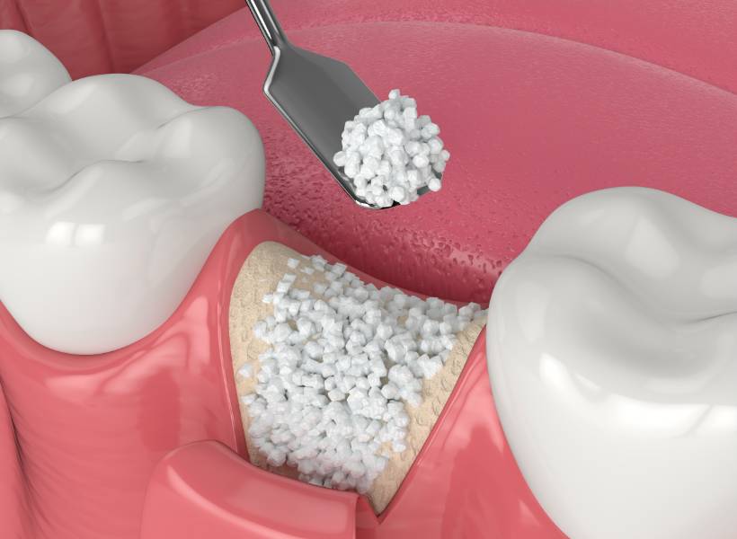 Bone graft